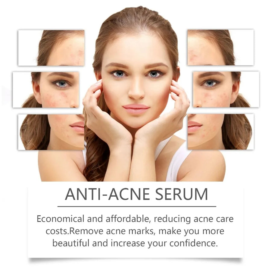 Hoygi Nicotinamide AntiAcne Serum Mild AntiAcne Serum Improve Acne Moisturizing Repair Serum